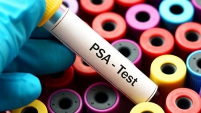 The PSA test is a blood test used primarily to screen for prostate cancer. (Instagram) The PSA test is a blood test used primarily to screen for prostate cancer. (Instagram)