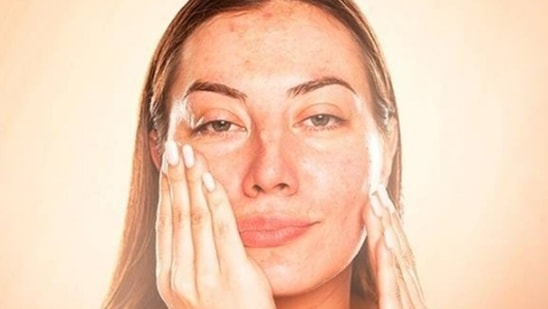 Tackling Melasma: Another problem that new mother face is Melasma which causes patches of discolouration. One is advised to use a good quality sunscreen of spf 30 or more. 