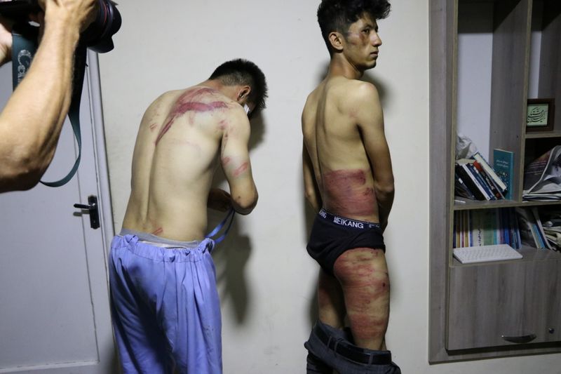 Jornalistas mostram seus ferimentos após serem espancados pelo Talibã em Cabul, Afeganistão, em 8 de setembro de 2021, nesta foto obtida nas redes sociais.  A foto foi tirada em 8 de setembro de 2021. & nbsp; (Etilaatroz / via REUTERS)