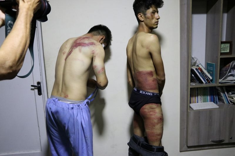 Journalists show their injuries after being beaten by the Taliban in Kabul, Afghanistan September 8, 2021, in this picture obtained from social media. Picture was taken on September 8, 2021.&nbsp; (Etilaatroz / via REUTERS)