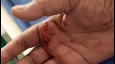 The man suffered injuries (in photo) in his hand after he was attacked with a screwdriver, said police on Thursday. (Sourced) The man suffered injuries (in photo) in his hand after he was attacked with a screwdriver, said police on Thursday. (Sourced)
