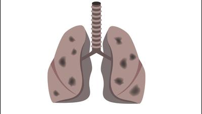 Pune doctors are reporting a sudden uptick in the number of bronchiolitis cases caused by Respiratory Syncytial Virus (RSV) infection in children. (Getty Images/iStockphoto (FOR REPRESENTATIONAL PURPOSE)) Pune doctors are reporting a sudden uptick in the number of bronchiolitis cases caused by Respiratory Syncytial Virus (RSV) infection in children. (Getty Images/iStockphoto (FOR REPRESENTATIONAL PURPOSE))