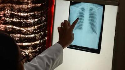 Shatabdi Hospital will recruit 75 patients for the trial. (PHOTO FOR REPRESENTATION) Shatabdi Hospital will recruit 75 patients for the trial. (PHOTO FOR REPRESENTATION)