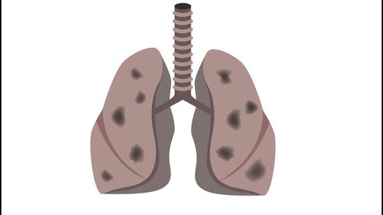 Pune doctors are reporting a sudden uptick in the number of bronchiolitis cases caused by Respiratory Syncytial Virus (RSV) infection in children. (Getty Images/iStockphoto (FOR REPRESENTATIONAL PURPOSE))
