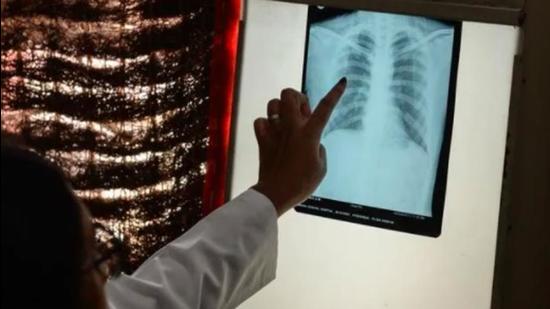 Shatabdi Hospital will recruit 75 patients for the trial. (PHOTO FOR REPRESENTATION)