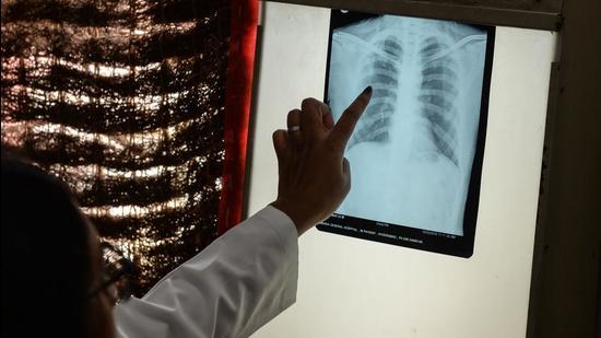 A doctor checks the chest X-ray of a patient. Generally referred to as Peeli Kothi clinic in the area, the site has originally housed the tuberculosis clinic from before Independence and was later upgraded to a modern chest clinic in 1999. (AFP File)