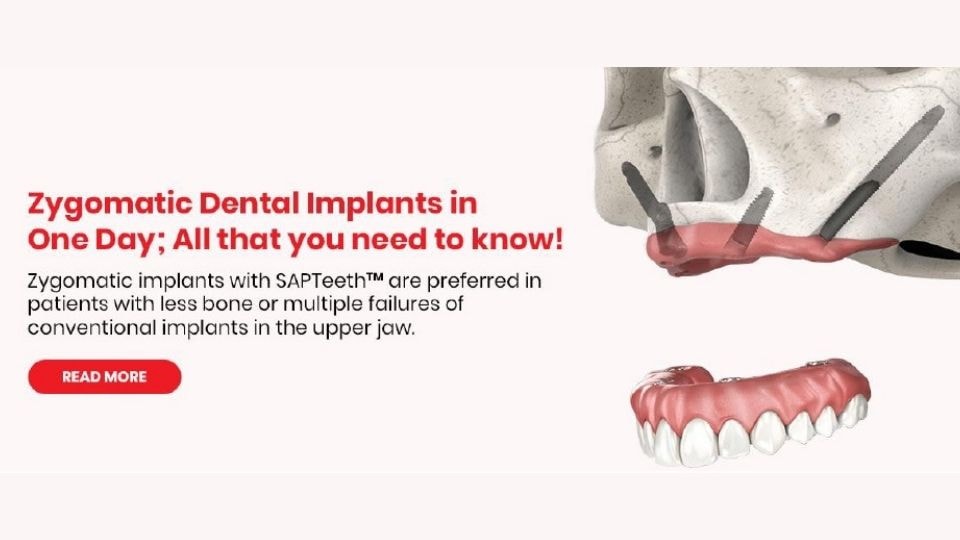 Royal Dental Clinics Kandivali, Mumbai, has to its credit more than 50 successful Zygomatic Implant placements. Royal Dental Clinics Kandivali, Mumbai, has to its credit more than 50 successful Zygomatic Implant placements.