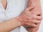 World Psoriasis Day is celebrated on October 29.(World Psoriasis Day) World Psoriasis Day is celebrated on October 29.(World Psoriasis Day)
