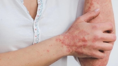 World Psoriasis Day is celebrated on October 29. (World Psoriasis Day) World Psoriasis Day is celebrated on October 29. (World Psoriasis Day)