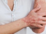 World Psoriasis Day is celebrated on October 29.(World Psoriasis Day) World Psoriasis Day is celebrated on October 29.(World Psoriasis Day)