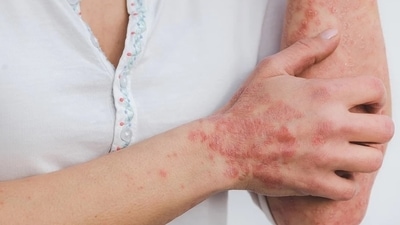 World Psoriasis Day is celebrated on October 29. (World Psoriasis Day) World Psoriasis Day is celebrated on October 29. (World Psoriasis Day)