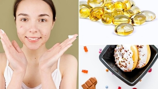 Clear skin is not only a sign of good health and vitality in your teenager, it is critical to helping every young person develop self-confidence and a positive self-image, says Nutritionist Pooja Makhija. She shares easy nutritional hacks for teens to deal with acne.(Pexels, Pixabay)