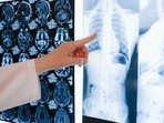 World Pneumonia Day is observed on November 12(Pexels) World Pneumonia Day is observed on November 12(Pexels)