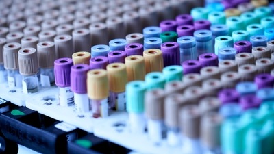 A recent study led by Sweden's Lund University has identified a protein in blood that could predict type 2 diabetes up to nineteen years prior to the onset of the disease. (Unsplash) A recent study led by Sweden's Lund University has identified a protein in blood that could predict type 2 diabetes up to nineteen years prior to the onset of the disease. (Unsplash)