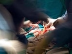 Doctors performed an 8-hour-long surgery to remove the tumour from the patient's liver. (Getty Images/ Representational image) Doctors performed an 8-hour-long surgery to remove the tumour from the patient's liver. (Getty Images/ Representational image)