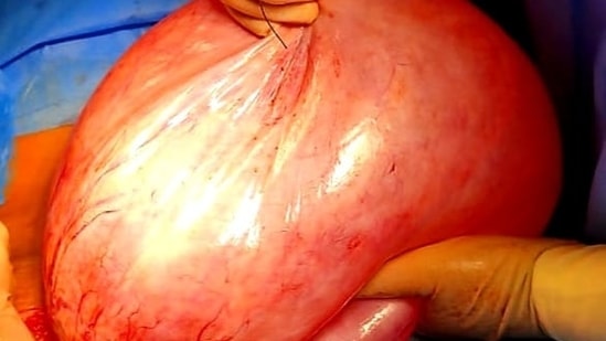 The reports revealed a cyst in the belly of women measuring 28 x25x20cm, prompting the doctors to suggest its surgical removal.(Fortis Hospitals) The reports revealed a cyst in the belly of women measuring 28 x25x20cm, prompting the doctors to suggest its surgical removal.(Fortis Hospitals)