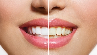 We often talk of having strong teeth, but forget to speak of the problems faced by people due to yellow teeth. The teeth gets yellow due to several reasons, such as smoking, mouth hygiene, genetical disorders or unhealthy diet. To avoid getting yellow teeth, these fruits can be included in the diet. We often talk of having strong teeth, but forget to speak of the problems faced by people due to yellow teeth. The teeth gets yellow due to several reasons, such as smoking, mouth hygiene, genetical disorders or unhealthy diet. To avoid getting yellow teeth, these fruits can be included in the diet.