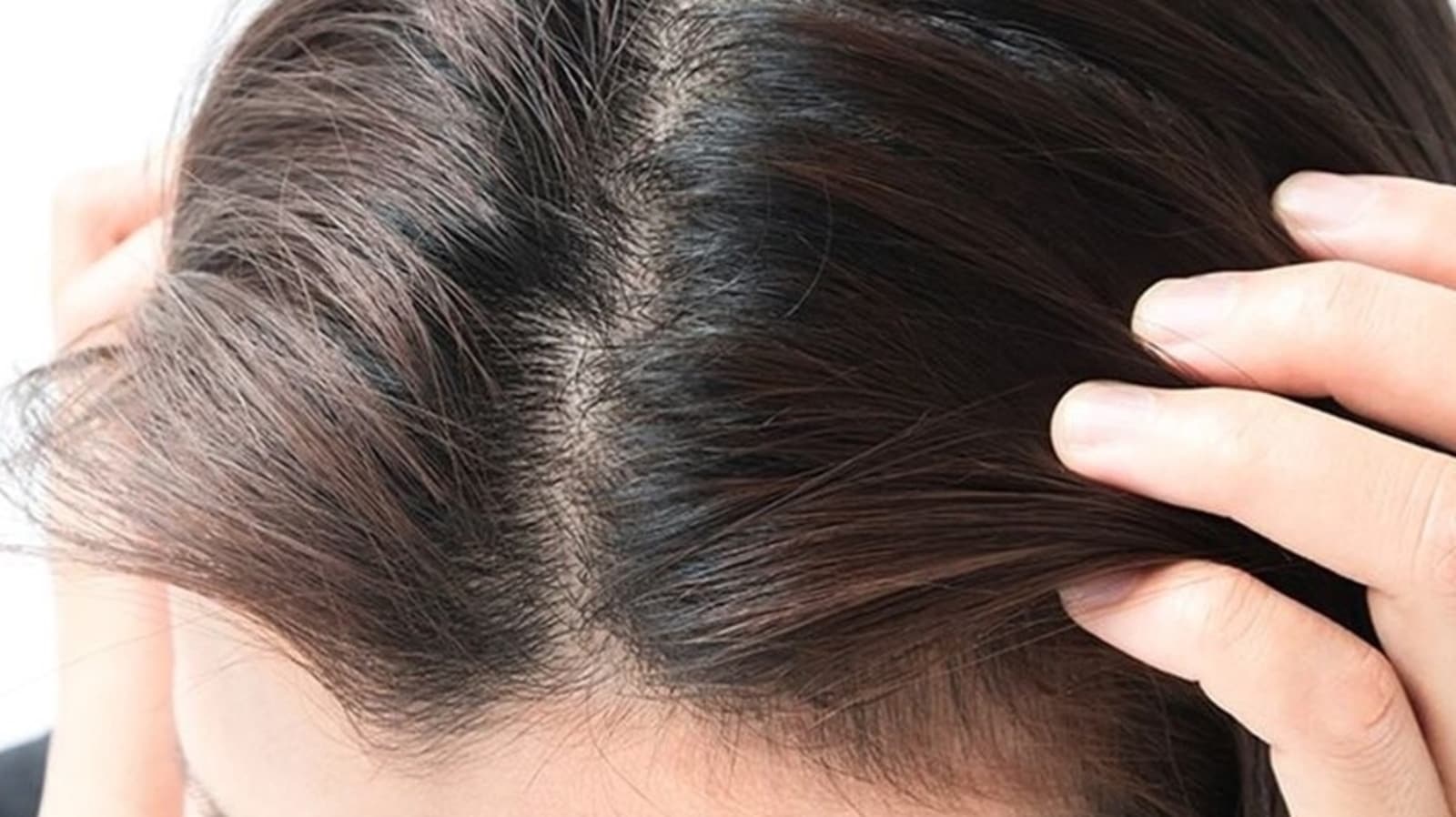 Troubled By Pimples On Your Scalp Here S How To Get Rid Of Them   Scalp Acne 1643529743381 1643529752931 