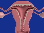 Ovarian cancer refers to any cancerous growth that begins in the ovary.