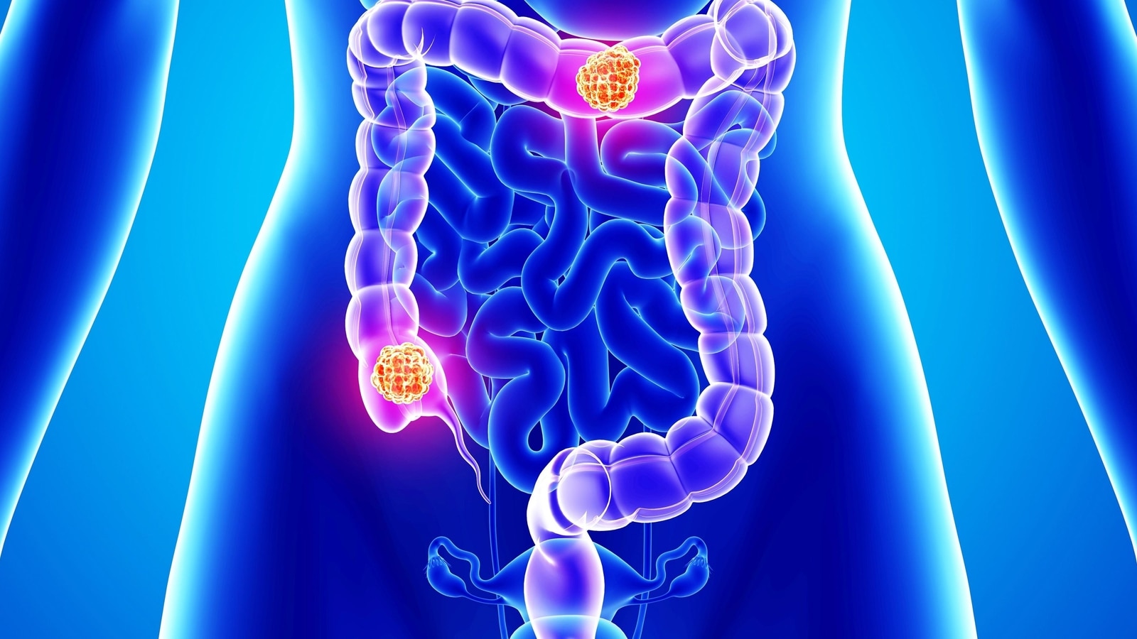 Doctors share health tips to keep colorectal cancer (CRC) risks at bay | Health