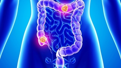 Doctors share health tips to keep colorectal cancer (CRC) risks at bay (Twitter/EvaSmartAI) Doctors share health tips to keep colorectal cancer (CRC) risks at bay (Twitter/EvaSmartAI)