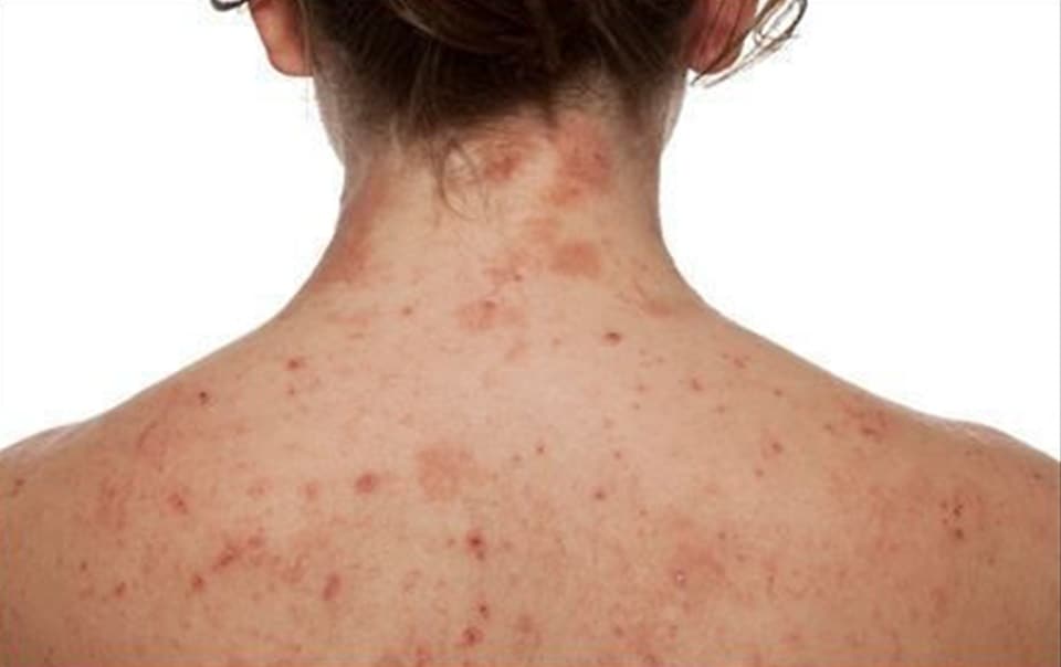 Atopic Dermatitis (AD) is a chronic inflammatory skin condition characterized by periods of flare, remission, or disease improvement. (Pinterest) Atopic Dermatitis (AD) is a chronic inflammatory skin condition characterized by periods of flare, remission, or disease improvement. (Pinterest)