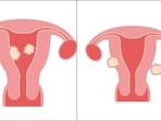 Fibroids: Doctor reveals types, causes, symptoms, risk factors, treatment of myomas (Pixabay) Fibroids: Doctor reveals types, causes, symptoms, risk factors, treatment of myomas (Pixabay)
