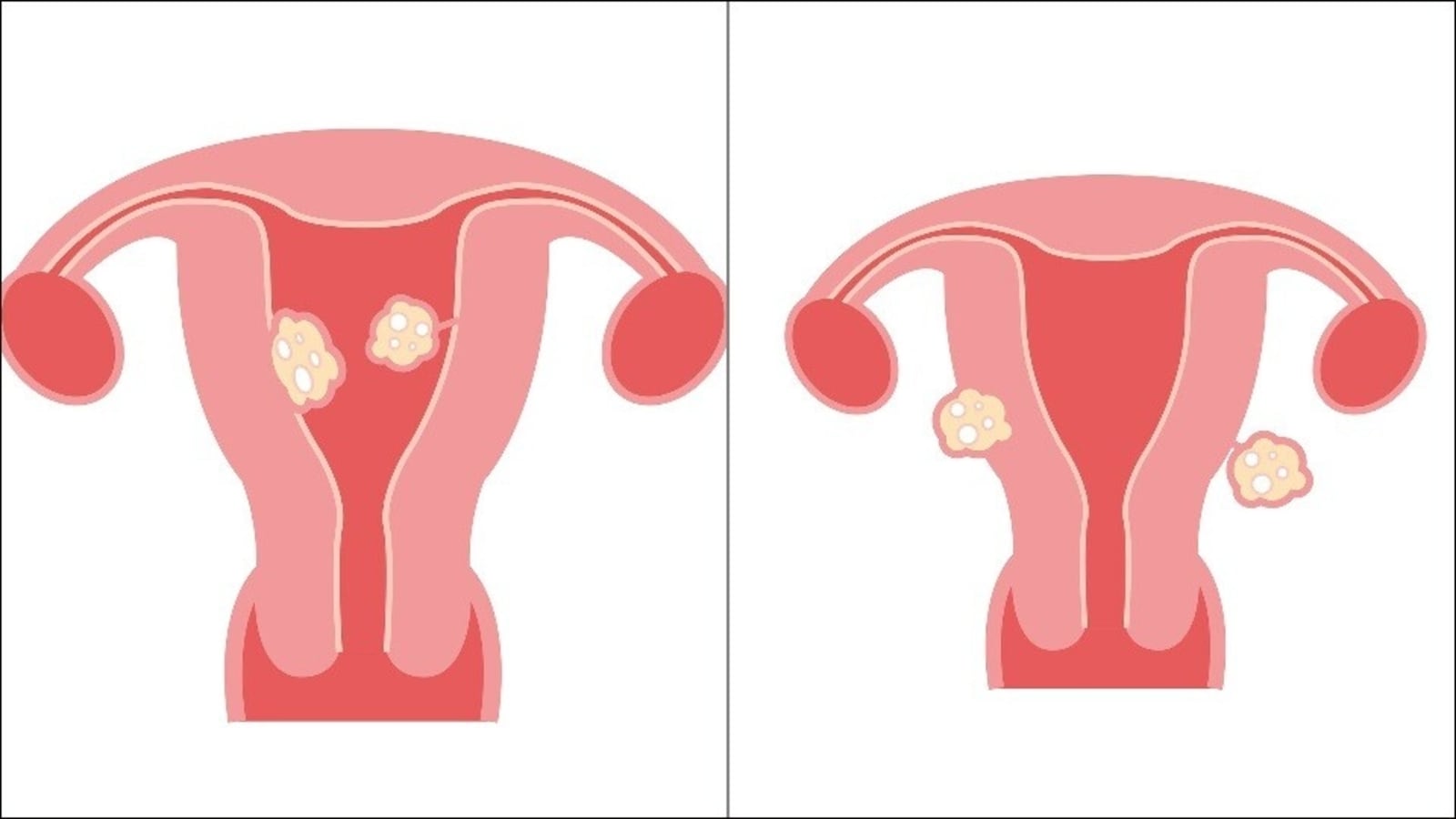 Fibroids Types Causes Symptoms Risk Factors Treatment Of Myomas By Doctor Health