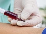 New study suggests causal link between blood group, severe covid-19 New study suggests causal link between blood group, severe covid-19