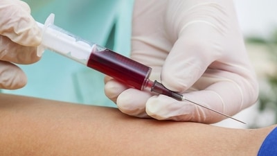 New study suggests causal link between blood group, severe covid-19 New study suggests causal link between blood group, severe covid-19
