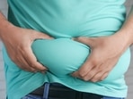 Obesity: Causes and preventive tips, as suggested by the doctors&nbsp;