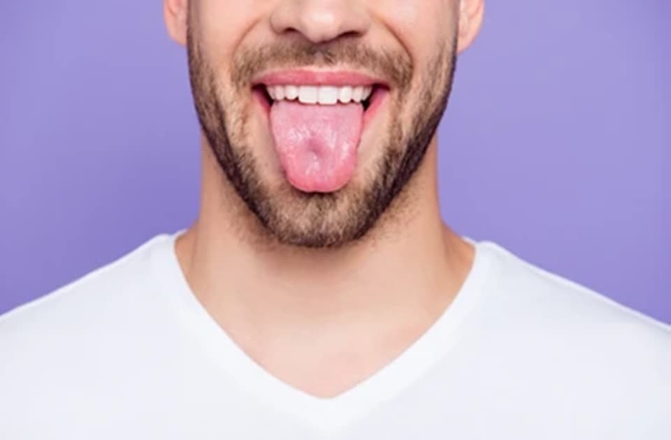 A man in his 50s who suffered from stroke three months back and was on a liquid diet apart from some medications, developed this harmless condition (Shutterstock)