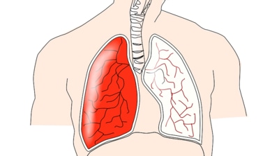 World Tuberculosis Day: Check out these 5 Yoga exercises to control TB symptoms (Pixabay) World Tuberculosis Day: Check out these 5 Yoga exercises to control TB symptoms (Pixabay)