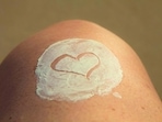 Expert tips on how to treat and manage burn scars and sun burn Expert tips on how to treat and manage burn scars and sun burn 