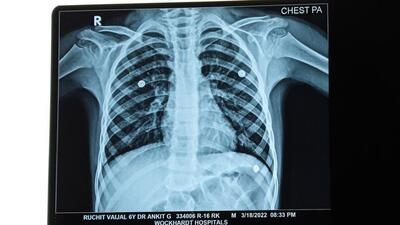 His parents expressed relief after the procedure. “Now, my son can breathe freely. He got a fresh lease of life after successful treatment,” his father said. (HT photo)