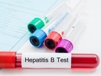 Hepatitis type A, B, C and E viruses that usually cause such illnesses have been ruled out in laboratory testing. (Shutterstock) Hepatitis type A, B, C and E viruses that usually cause such illnesses have been ruled out in laboratory testing. (Shutterstock)