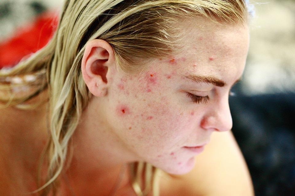 Endometriosis causes hormonal imbalance which could lead to acne (Pixabay) Endometriosis causes hormonal imbalance which could lead to acne (Pixabay)