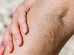 Varicose veins: Causes, symptoms, fitness tips to deal with it during summer Varicose veins: Causes, symptoms, fitness tips to deal with it during summer 