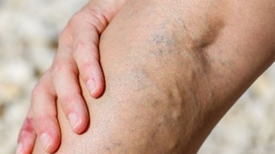 Varicose veins: Causes, symptoms, fitness tips to deal with it during summer&nbsp;(Twitter/vein_at)