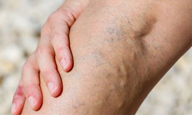 Varicose veins is more common in legs as due to standing and walking pressure is exerted on the veins of the lower body. (Twitter/vein_at)