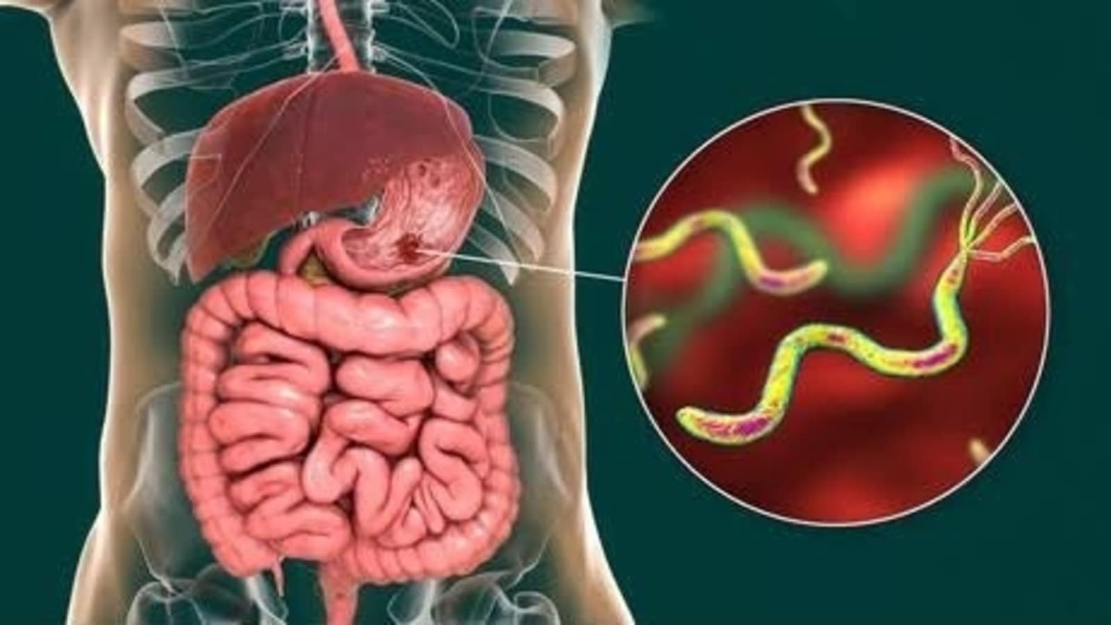 Ulcer Doctors reveal causes symptoms you should never ignore 