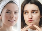 Pimples can be both painful and embarrassing.