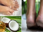 Dr. Shareefa Chause, Dermatologist, Apollo Spectra Mumbai in an interview with HT Digital suggests very simple home remedies to treat cracked heels. Dr. Shareefa Chause, Dermatologist, Apollo Spectra Mumbai in an interview with HT Digital suggests very simple home remedies to treat cracked heels.