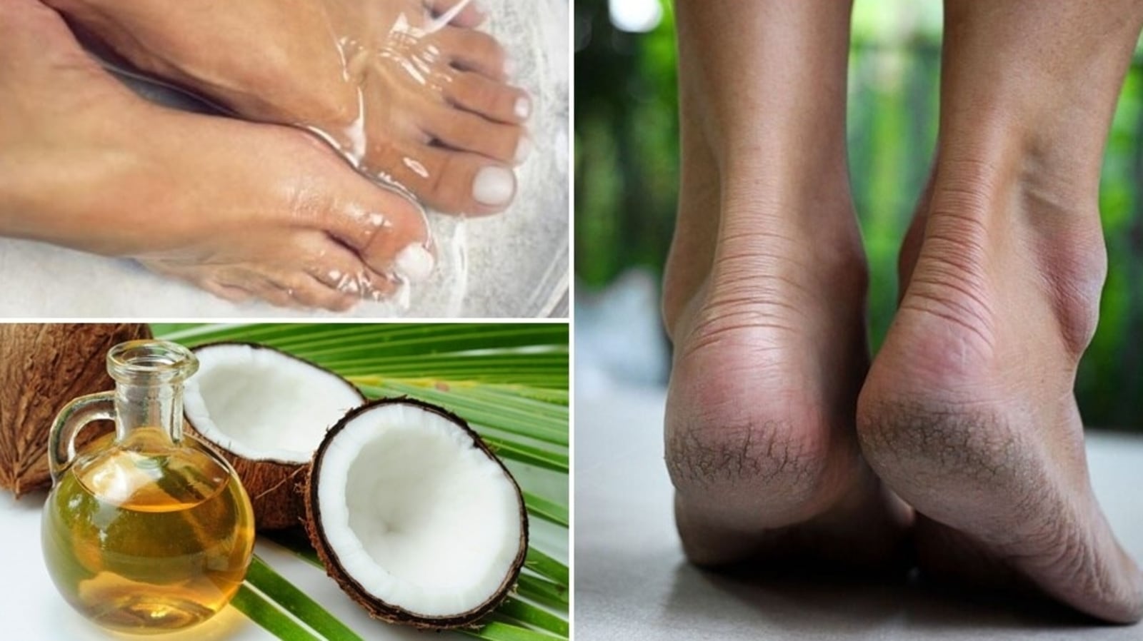 Tired of Cracked Heels? Cure it With These Home Remedies