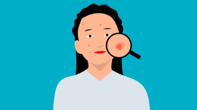 Why do we get skin allergies? Health experts share causes, symptoms, treatment (Pixabay) Why do we get skin allergies? Health experts share causes, symptoms, treatment (Pixabay)