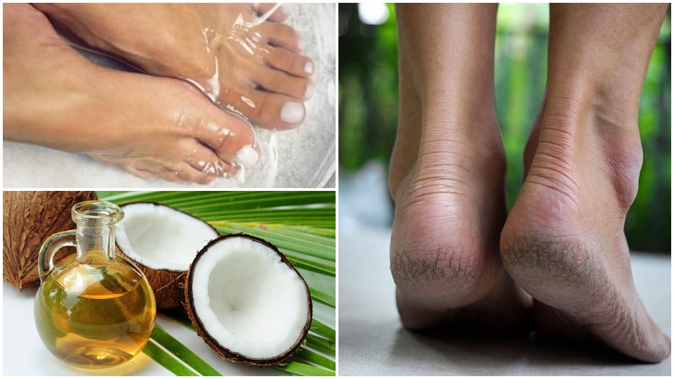 Dr. Shareefa Chause, Dermatologist, Apollo Spectra Mumbai in an interview with HT Digital suggests very simple home remedies to treat cracked heels. (Pinterest)