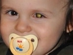 World Retinoblastoma Awareness Week: Doctor reveals symptoms, precautions and treatment (Twitter/KAKSStiftung) World Retinoblastoma Awareness Week: Doctor reveals symptoms, precautions and treatment (Twitter/KAKSStiftung)