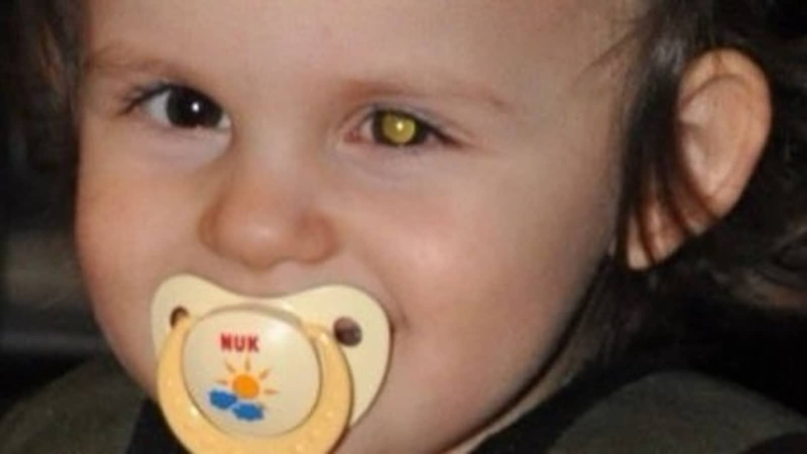 World Retinoblastoma Awareness Week Symptoms, precautions and