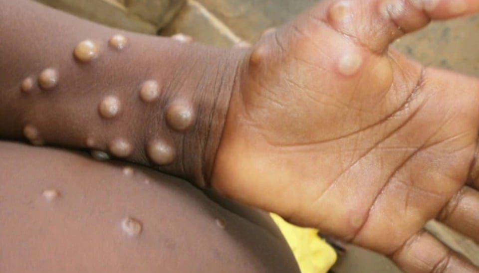 At the outset a patient infected with monkeypox will have symptoms like fever, headache, chills, body ache, exhaustion. (WHO)