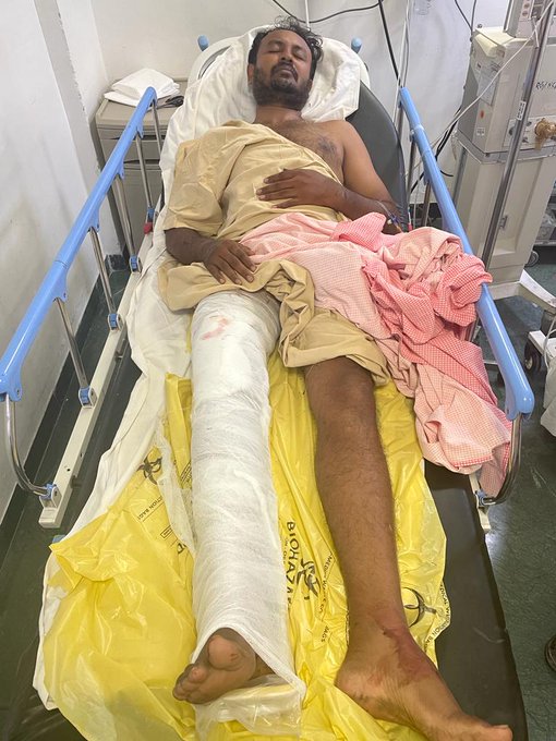 Nagesh Babu, the wanted acid attack accused, was shot in the leg by police after he allegedly tried to escape near Kengeri on Friday. Nagesh Babu, the wanted acid attack accused, was shot in the leg by police after he allegedly tried to escape near Kengeri on Friday.